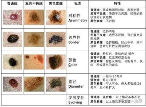 身體的痣|痣是什麼？會變成黑色素瘤？7種一定要除的痣